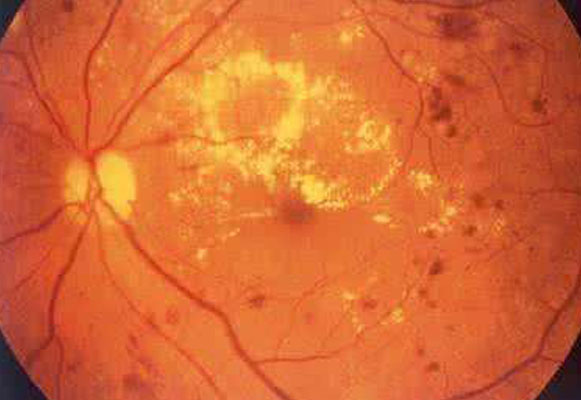 并发症视网膜病变眼底出血导致双目失明如何治疗安全_哪里有医药项目合作哪里治疗好-常德市武陵区湘康中医诊所