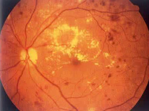 并发症视网膜病变眼底出血导致双目失明如何治疗有效_医药项目合作哪里治疗快-常德市武陵区湘康中医诊所