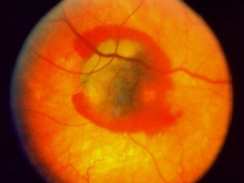 糖尿病并发症视网膜病变眼底出血导致双目失明_并发症视网膜病变眼底出血导致双目失明