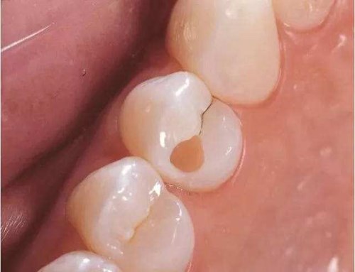 牙痛龋病治疗_牙痛