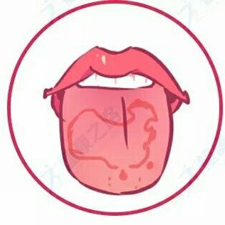 治疗舌炎