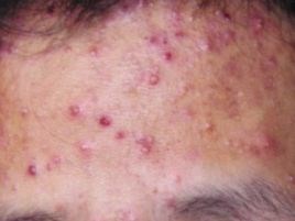 毛囊炎是怎么引起的_皮肤医药、保养治疗方法-芜湖中科皮肤病研究院