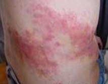 带状疱疹是怎么引起的_头部带状疱疹是怎么引起的_芜湖中科皮肤病研究院