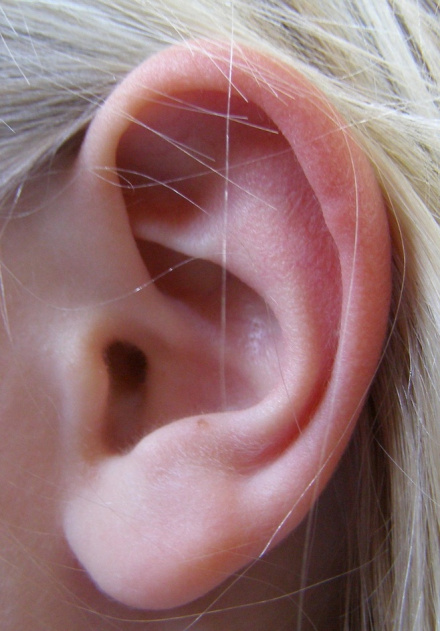 山东孩子耳朵缺损怎么恢复快_哪儿治疗耳朵缺损修复_耳再造