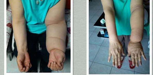 德州上肢淋巴水肿如何治疗手术后医药项目合作受阻济南106医院